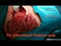 Malrotation surgery  lecture  ladds operation  explaination for educational purposes only