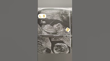 NT scan report girl baby#NT scan#boy baby#girl baby#