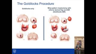 Goldilocks Procedure With Without Immediate Implant-based Breast Reconstruction in Obese Patients