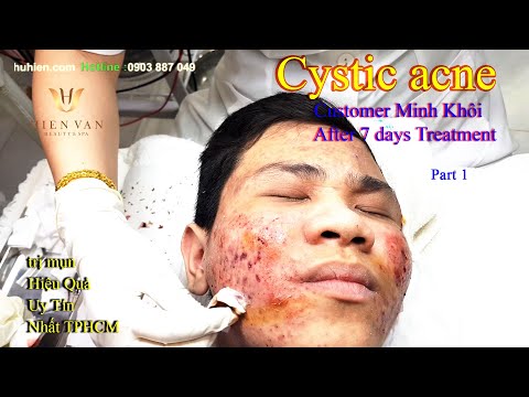 Video Cách Điều Trị Mụn Viêm, Mụn Bọc Hiệu Quả Nhất TPHCM... - youtube