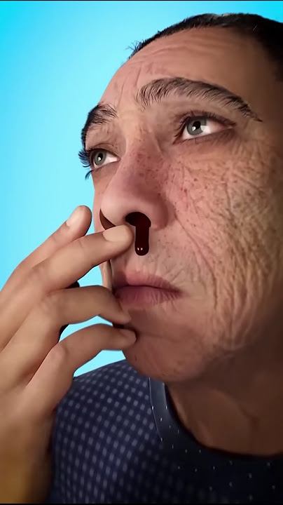 How to stop nosebleeds? 😱