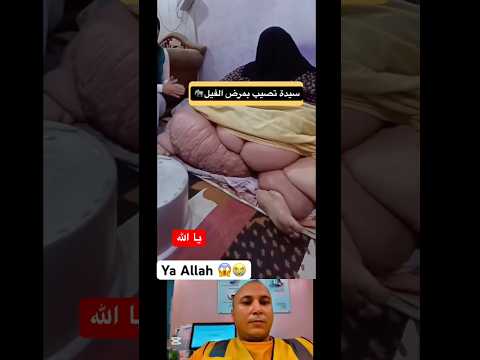 فديو مؤاثر لسيدة أصيبت بمرض الفيل 