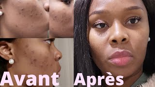 COMMENT se débarrasser des BOUTONS et TACHES sur le visage ? (ROUTINE Ducray) | Samantha MK