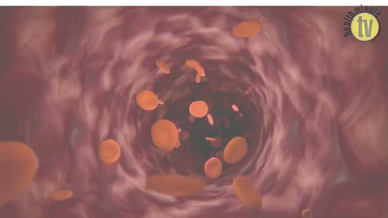 VIDEO: Melanoma immune cell composition may predict benefit from combination immunotherapy