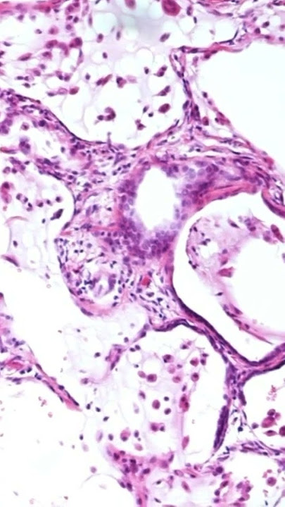 The Histology of UIP in Idiopathic Pulmonary Fibrosis (IPF)