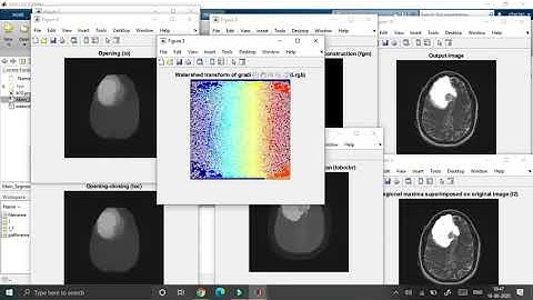 Brain Tumor detection using Matlab || machine learning