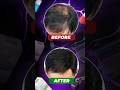 Top 10 Hair Loss Treatments - Ranked by NEW hair growth