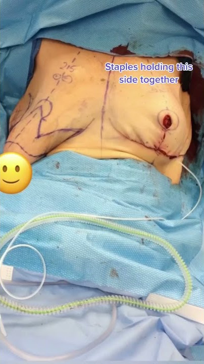 Droopiest Breasts get Lifted #shorts