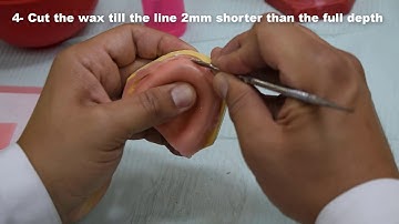 Complete denture 1 PRS242 ( Spacer & Special Tray)