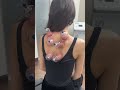 Best Cupping Therapy in Beverly Hills #chiropractor #backpain