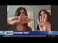 Simple thumbpalm test may help detect likelihood of aneurysm