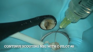 Cleaning and shaping 4 root canals in one session with HyFlex EDM