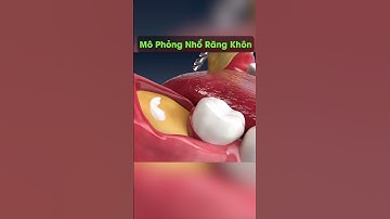 Nhổ răng khôn mọc ngầm sẽ như thế nào? #shorts #youtubeshorts #trending