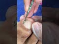 Satisfying  pedicure tutorial ,ingrown toenail and apply cutex 😍