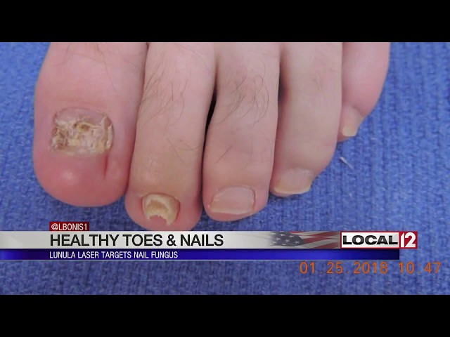 Lunula Laser targets nail fungus