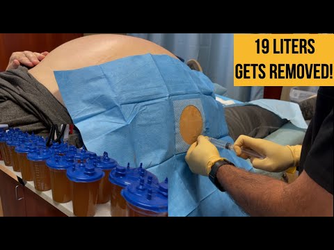 Video: How To Remove A Guy's Belly