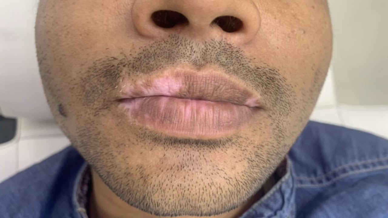 Lip Vitiligo Surgery Dr Anvika Mittal Youtube