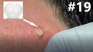 BLACKHEAD EXTRACTION on Happy #19