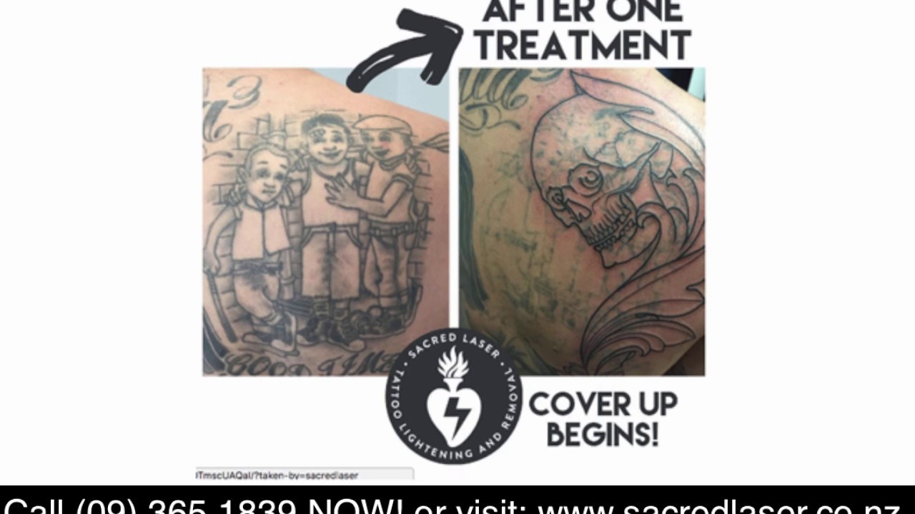 Laser tattoo removal  Auckland Dermatology