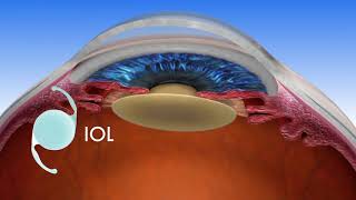 Florida Eye - LENSAR Laser Assisted Cataract Surgery