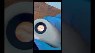 Dermatoscope Ver Descripción See Description