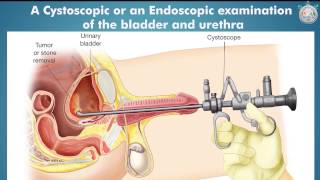 Don’t Ignore Blood in Urine (Hematuria) | India Medical Hub