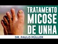 Tratamento de Micose de Unha - Dr. Paulo Müller Dermatologista.