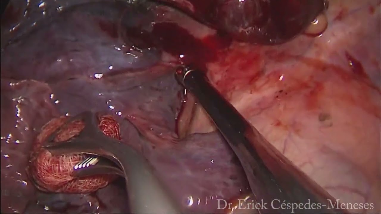 Uniportal VATS right upper lobectomy. Bleeding control