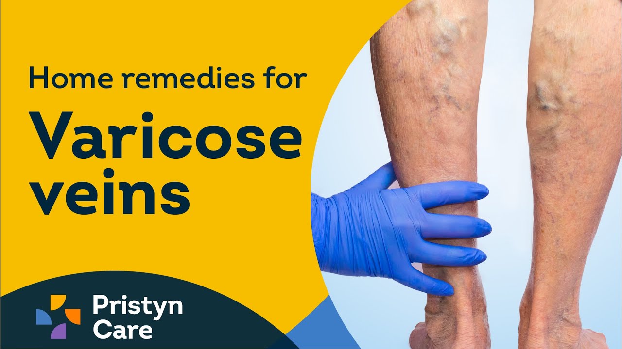 The 9 best ways to treat varicose veins