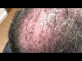 Dallas Male Hair Transplant Testimonial One Day Out
