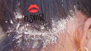 Extreme Scalp Transformation | Thick Dandruff Removal ASMR D00367