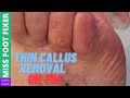 Thin Callus Removal on Toe | Miss Foot Fixer |  Marion Yau