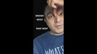 Broken Nose 😫 Now What?