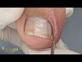 A dor era imensa e quase ninguém via o problema, mas estava bem ali!! #satisfying #nails