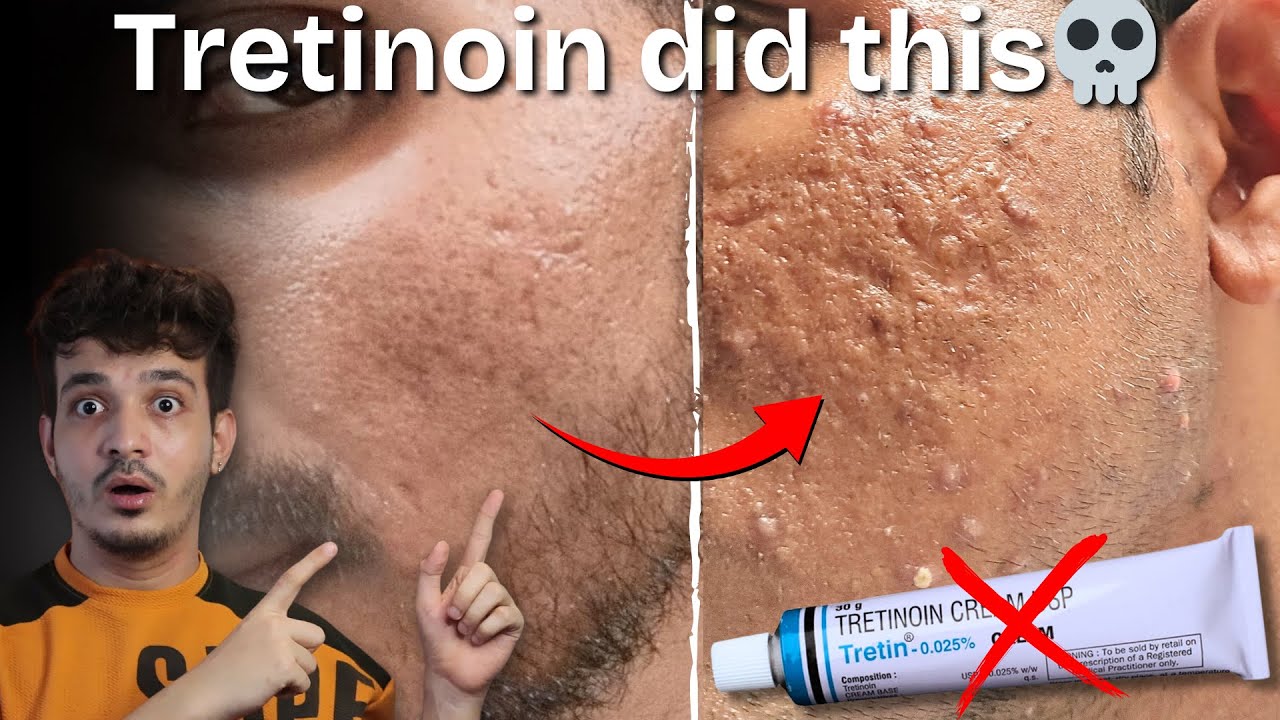 WARNING! Tretinoin Can DESTROY Your Face 😨