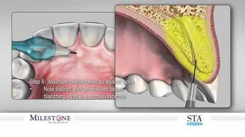 P-ASA Injection| The Wand