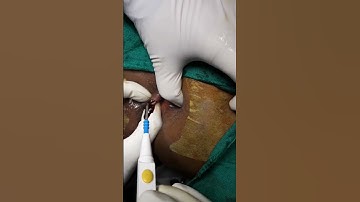 Piles | How External Thrombosed Piles are Drained | Hemorrhoids | बवासीर