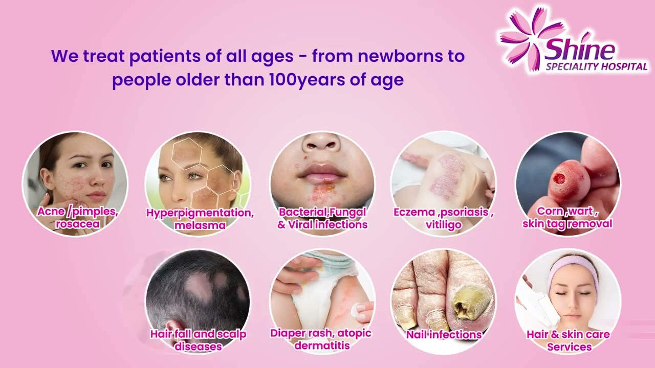 Complete solution for all types of skin problems.𝐃𝐫.𝐃.𝐕𝐈𝐒𝐖𝐀𝐌𝐁𝐇𝐀𝐑𝐈 @ 𝐒𝐡𝐢𝐧𝐞 𝐒𝐩𝐞𝐜𝐢𝐚𝐥𝐢𝐭𝐲 𝐇𝐨𝐬𝐩𝐢𝐭𝐚𝐥.