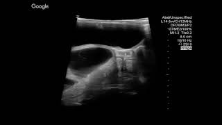 Bowel Obstruction \& Fecal Retention (2\/2)