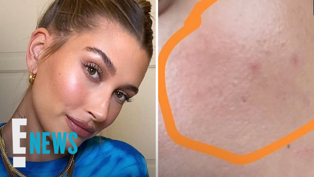 Hailey Bieber Gets Real About Skin Condition News