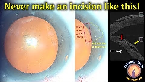 Never make your cataract surgery incision like this!