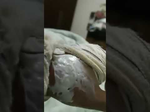 Síndrome rara,com uso de bomba de morfina!