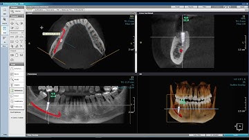 Part 5, OnDemand 3D CBCT software, implant site analysis 2nd part, by Dr Khaled Ekram (in English)