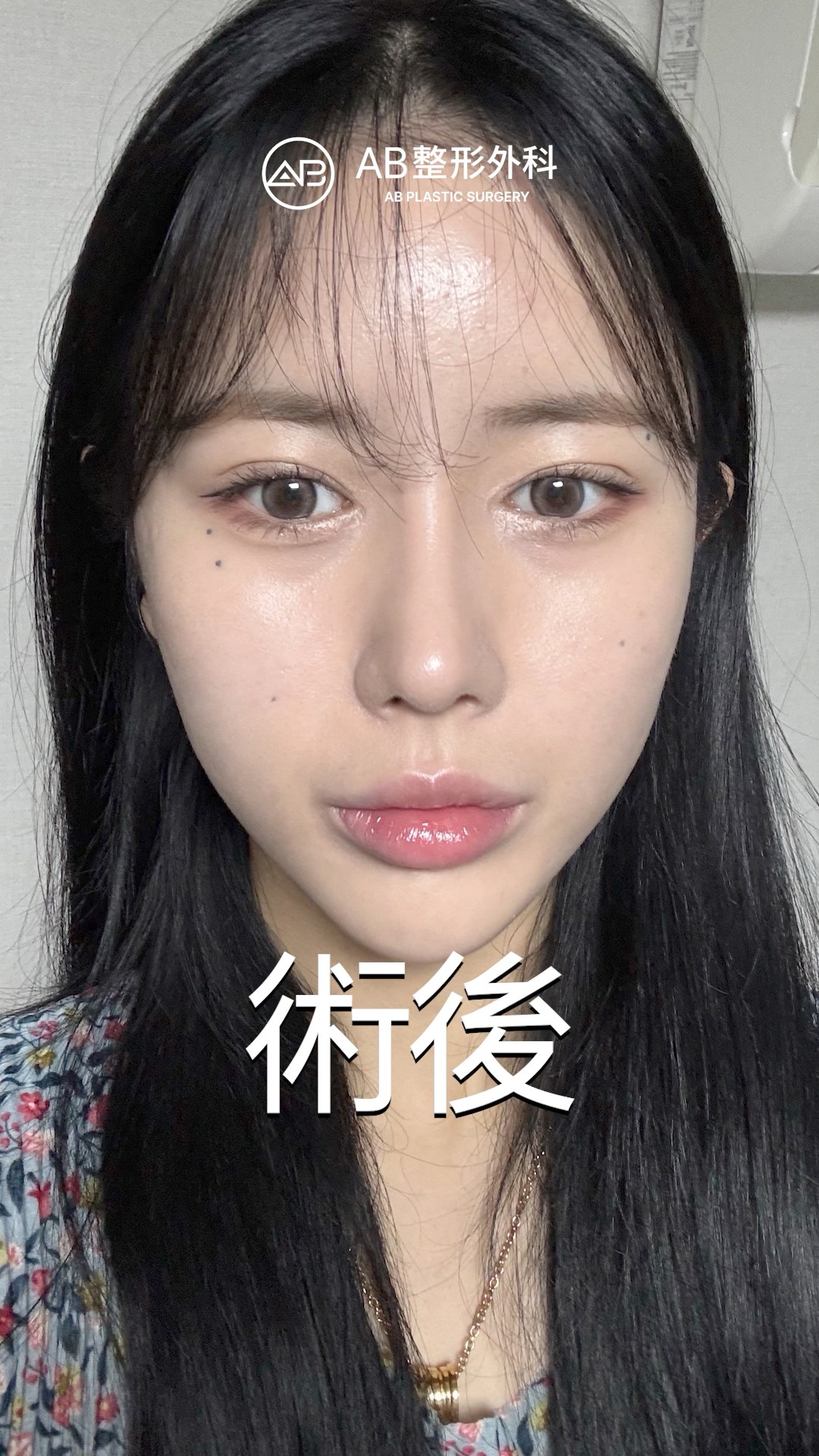 鼻整形後，整個氣質都不一樣了。 #shorts