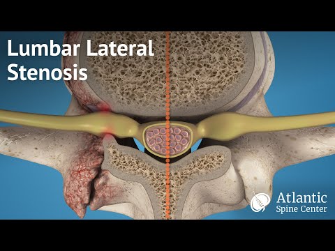 LumbarLumbarspinal stenosisLumbarLumbarspinal stenosiscan press on the spinal cord and the nerves th. 