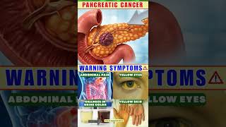 8 WARNING Signs of Pancreatic Cancer You Should Know