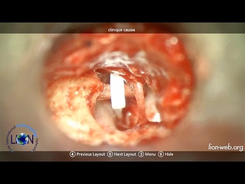 Live Surgery Primary Surgery For Far Advanced Otosclerosis (Robert Vincent)