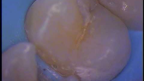 Class II - composite restorations using a rubber dam for isolation 1/3