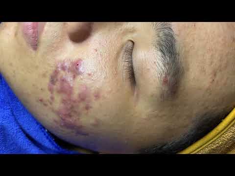 Acne Treatment For Hoang (P2) | Điều Trị Mụn Cho Bạn Hoàng (P2) - SacDepSpa#269