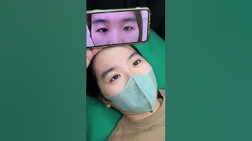 Cắt mí Double Deep 2808